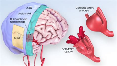 Subarachnoid Hemorrhage Symptoms & Treatment | Stroke & Aneurysm Center