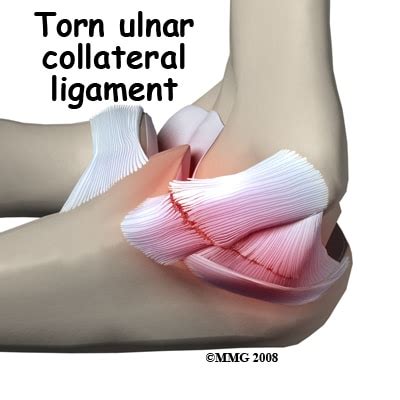 6 Common Reasons For Pain In The Elbow – Howard J. Luks, MD