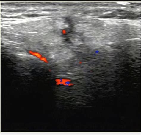 Ultrasound scan of the parotid gland shows a linear hypoechoic focus in ...