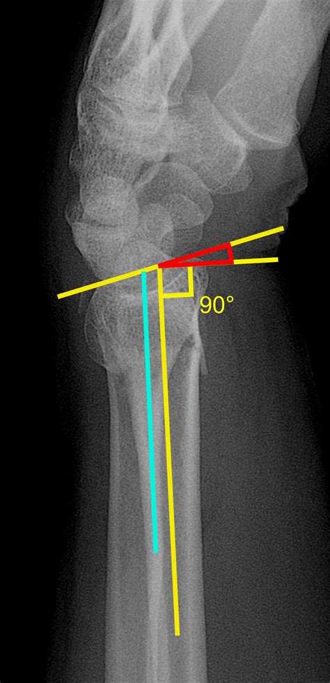 Distal radius fracture x ray - wikidoc