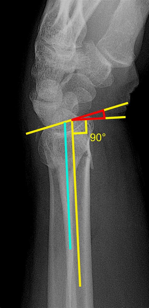 Distal Radius Fracture X Ray