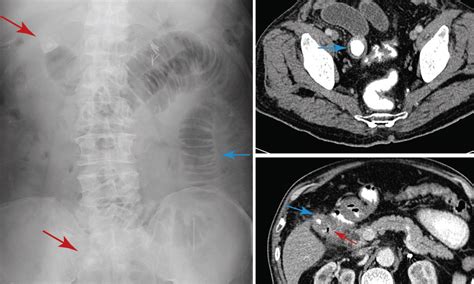 Gallstone ileus | The Medical Journal of Australia