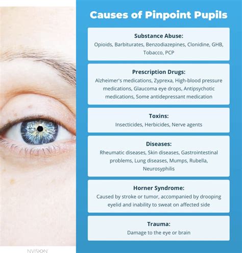 Why Do I Have Pinpoint Pupils? 6 Causes – NVISION