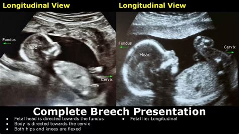 Fetal Presentations Ultrasound Images | Cephalic/Breech/Frank/Footling ...