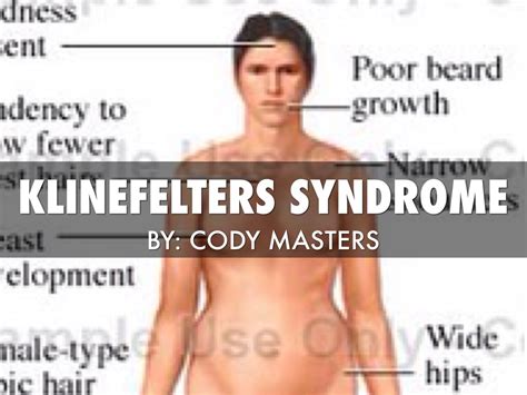 Klinefelter S Syndrome Causes Symptoms Diagnosis Treatment | The Best Porn Website