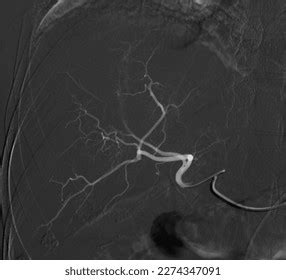 Imaging Tace Chemoembolization Procedure That Allows Stock Illustration 2274347091 | Shutterstock