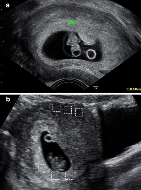 Yolk Sac Ultrasound