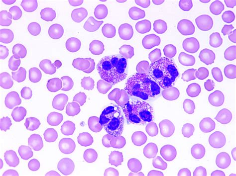 Prepare for Medical Exams : High Eosinophil Count on routine blood work ...