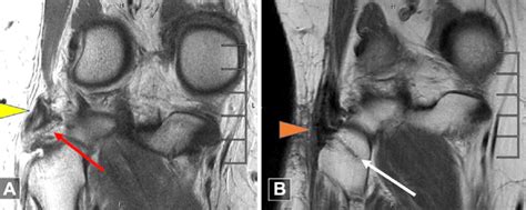 (A) MRI showing PLC avulsion injury with biceps femoris tendon (yellow... | Download Scientific ...