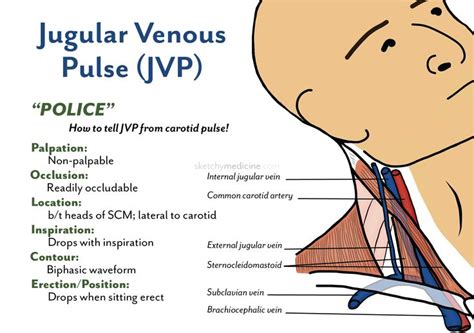 Sketchy Medicine | Jugular venous pressure, Nursing school notes, Medical knowledge