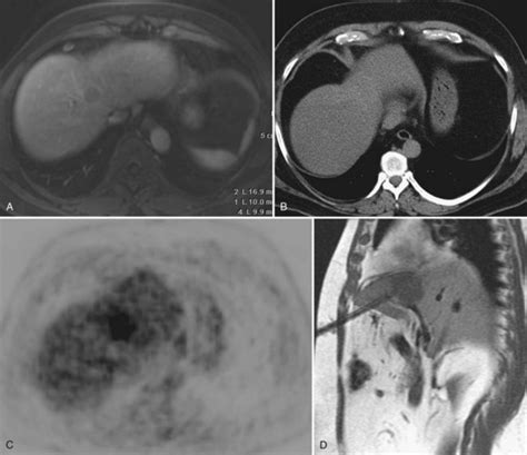 Percutaneous biopsy | Abdominal Key