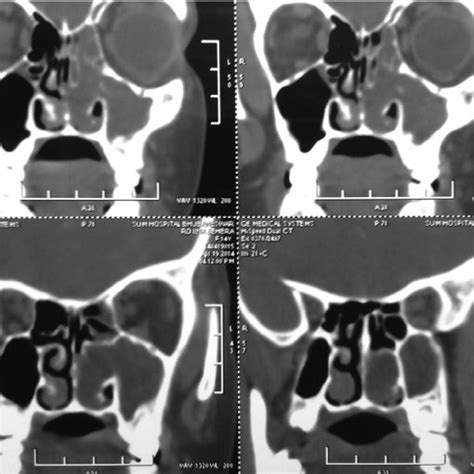 CT scan showing soft tissue attenuation in the left nasal cavity and ...