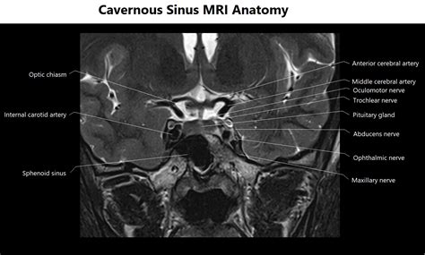 Cavernous Sinus MRI | MRI Cavernous Sinus Protocol and Planning