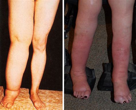 Causes Of Lymphedema Lower Leg