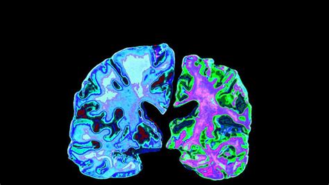 What is Alzheimer's disease? | New Scientist