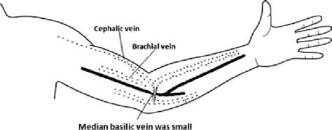 Radio-cephalic arteriovenous fistula with problems. | Download Scientific Diagram