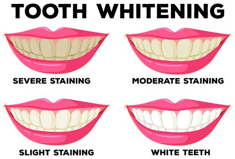 Process of tooth whitening 296570 Vector Art at Vecteezy