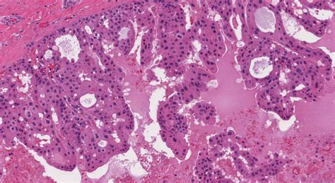 Salivary duct carcinoma | Ottawa Atlas of Pathology