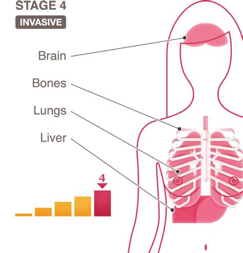 Stage 4 - National Breast Cancer Foundation