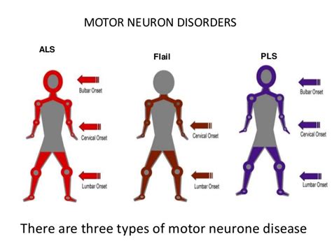 Very Early Signs Of Motor Neurone Disease - Bangmuin Image Josh