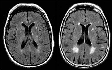 Health Information Guides: Brain MRI White Matter Intensities: Clinical Significance