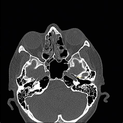 Figure 1 from Prevalence of Carotid Canal Dehiscence Facing with Middle ...