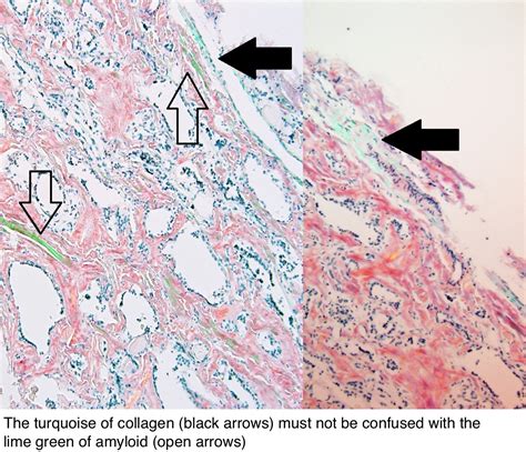 Pathology Outlines - Congo red