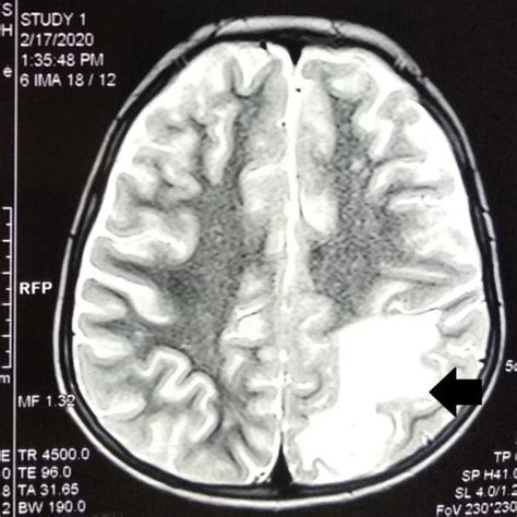 Multiple round to oval lesions in the left frontal and parietal lobe ...