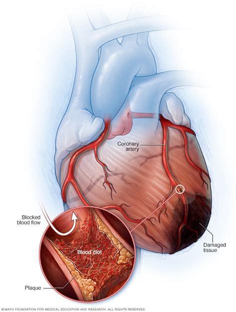 Heart attack - Symptoms and causes - Mayo Clinic