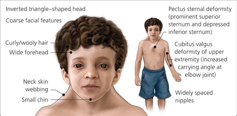 Noonan Syndrome | AAFP