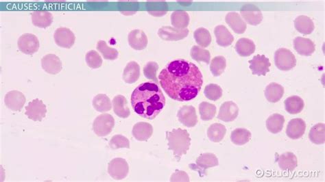 Burr Cells | Causes & Significance - Lesson | Study.com