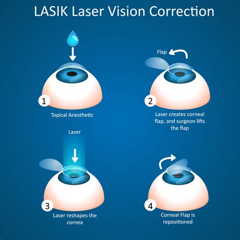 Houston LASIK Vision Correction • Houston,TX • Katy,TX • Whitsett ...