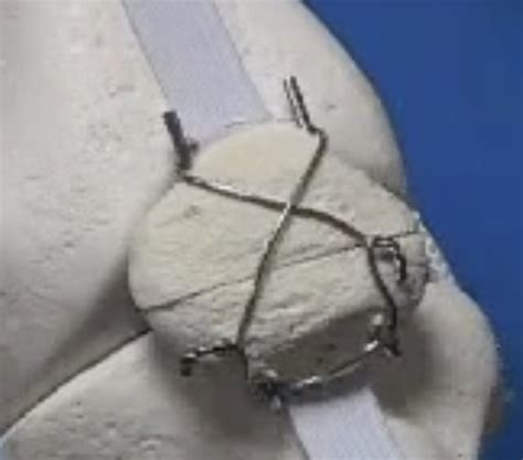 Broken kneecap surgery | b-reddy.org