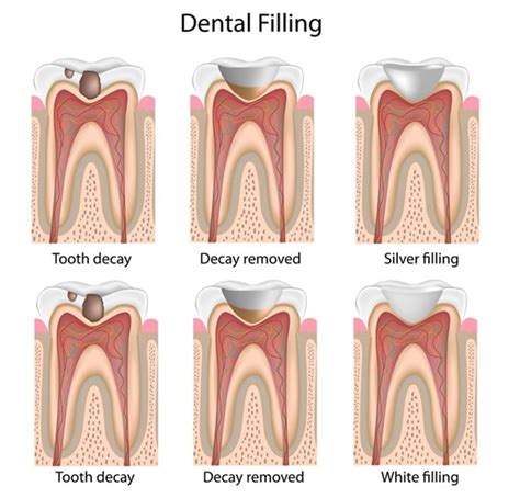 Restoration of Tooth Decay | Dental Services | Martin Familiy Dentistry