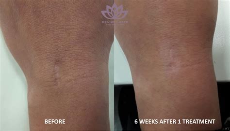 Scar Laser Treatments in Calgary | Revive Laser