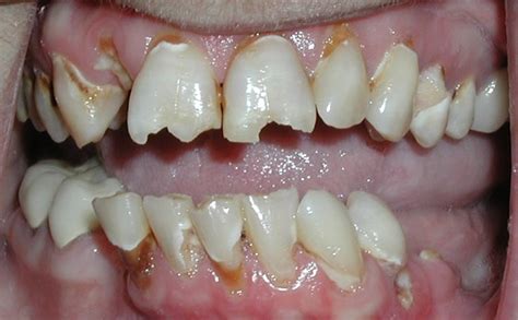 Rotten Teeth Pictures | New Health Advisor