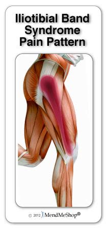 Iliotibial band syndrome (ITBS)