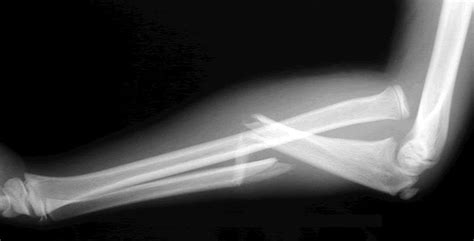 Monteggia fracture - fracture of ulna with radial dislocation ...