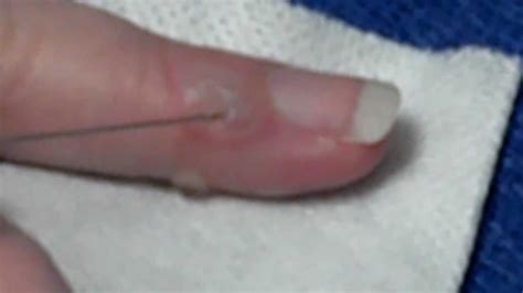 Popping my burn blister - YouTube