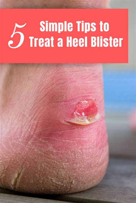 How to Treat a Deep Heel Blister (4 Steps) - Train for a 5K.com | Heel blisters, How to treat ...