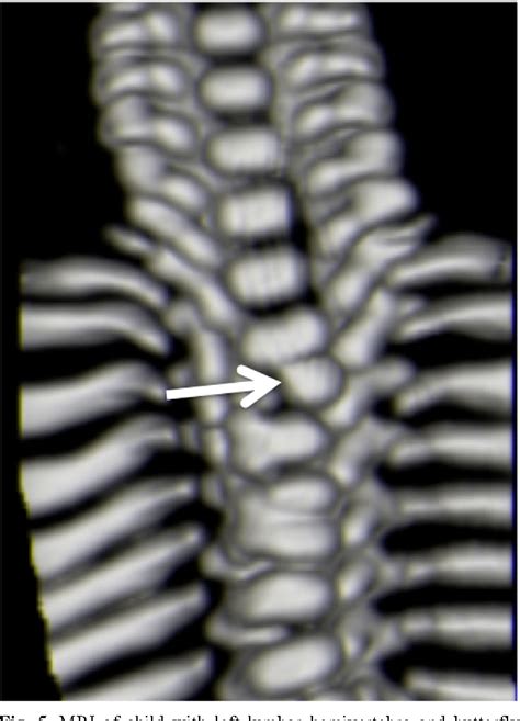 Hemivertebrae: a comprehensive review of embryology, imaging ...