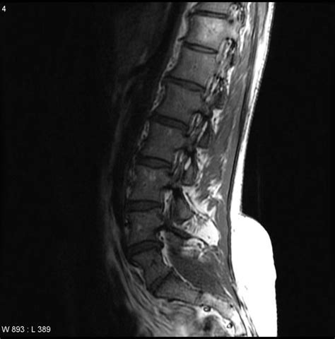 Lipomyelomeningocele and tethered cord: MRI of the lumbar spine demonstrates a low lying conus ...