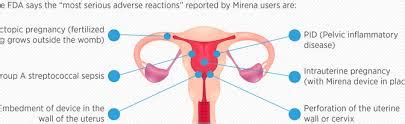 Mirena IUD problems - Fix Hormones Naturally