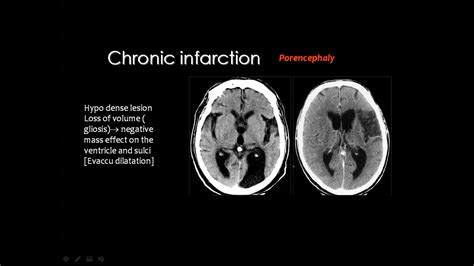 Gliosis Mri - IMobile Cool