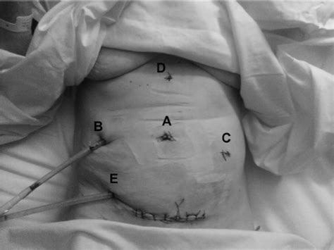 Port placement for combined procedure. | Download Scientific Diagram