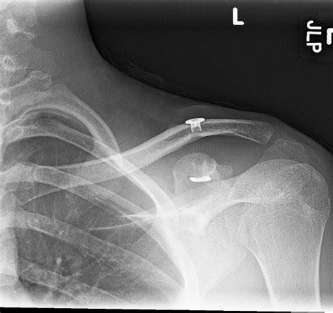 Shoulder Dislocation | Shoulder Separation | Vail, Aspen, Denver CO