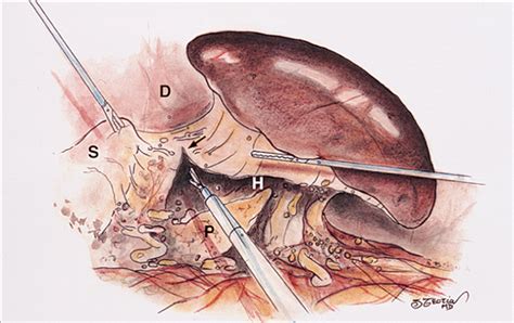 Laparoscopic Splenectomy | Minimally Invasive Surgery | JAMA Surgery ...