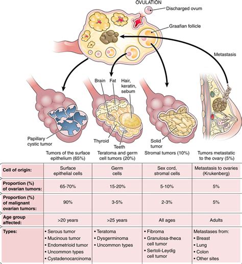 Ovarian Cancer | Diseases & Conditions | 5MinuteConsult