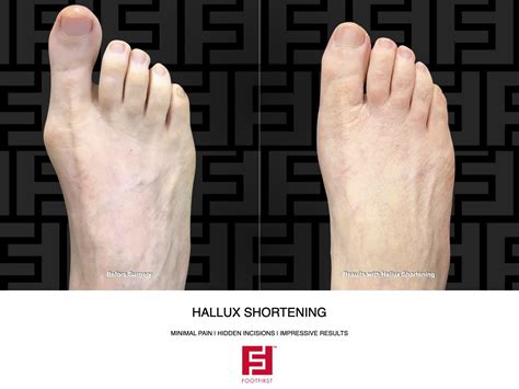 Can you Shorten the Big Toe? — Foot First Podiatry Centers