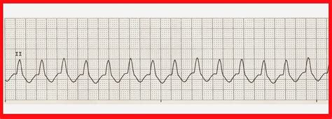 Practice EKG Rhythm Strips 219